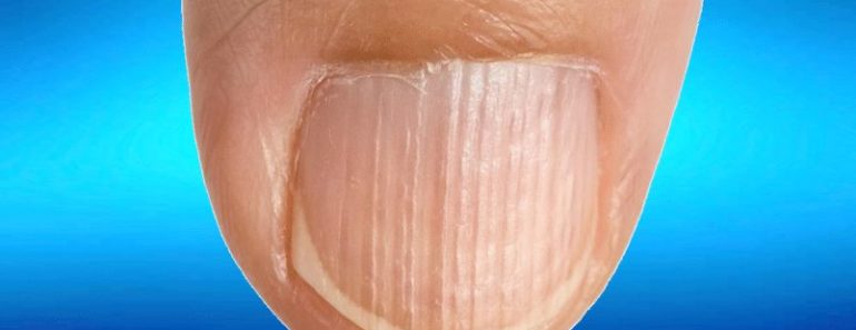 Señales que tu cuerpo te dará ante una deficiencia de proteínas