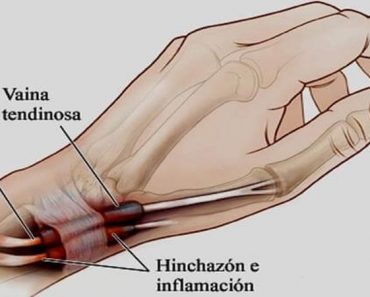Los dolores de las manos y pies tal vez no es artritis sino tenosinovitis; así se soluciona.