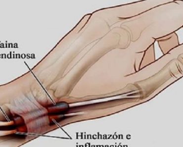 Los dolores de las manos y pies tal vez no es artritis sino Tenosinovitis; así se soluciona.