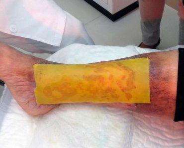 Científicos crean un parche de miel capaz de cicatrizar el pie diabético
