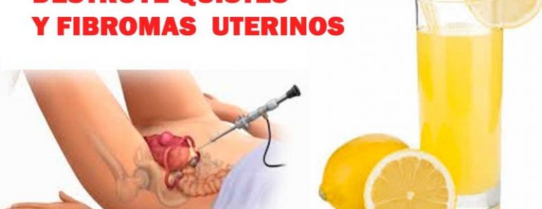 Antiguo Remedio que Elimina Quistes en los Ovarios en Pocos Dias Antiguo Remedio que Elimina Quistes en los Ovarios en Pocos Dias