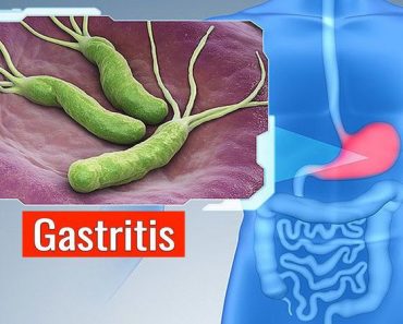 Cinco Remedios Caseros Para la Gastritis, el #1 es el Más Efectivo