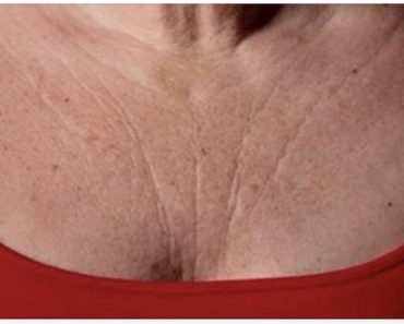 Estos son los remedios naturales para borrar las arrugas del pecho y el cuello Estos son los remedios naturales para borrar las arrugas del pecho y el cuello