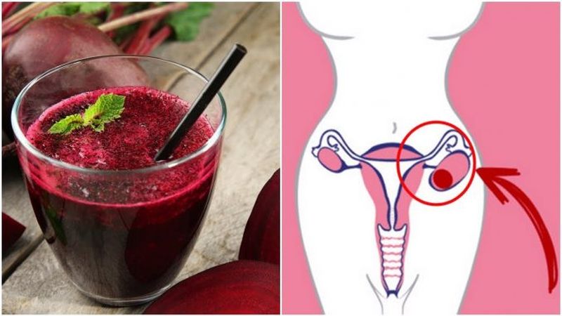 Alimentos para eliminar los quistes ovaricos