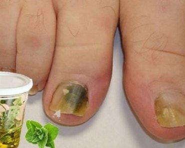 Con unas Gotitas de Orégano al Día o Estos Otros Remedios, Los Hongos de tus Uñas se Secarán por Completo. Con unas Gotitas de Orégano al Día o Estos Otros Remedios, Los Hongos de tus Uñas se Secarán por Completo.