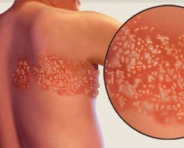 Culebrilla: la enfermedad que se activa con el estrés y podría causar ceguera