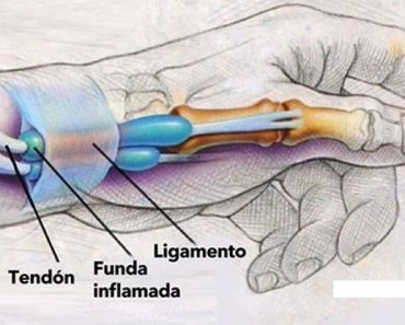 Ocho ejercicios para curar la Tendinitis o Tenosinovitis de Quervain