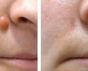 Elimina Fibromas, Verrugas Genitales Y Faciales, Manchas, Espinillas Y Más Con Estos Remedios Caseros Elimina Fibromas, Verrugas Genitales Y Faciales, Manchas, Espinillas Y Más Con Estos Remedios Caseros