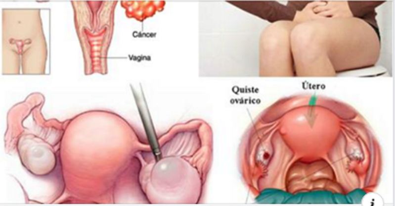 ovarios