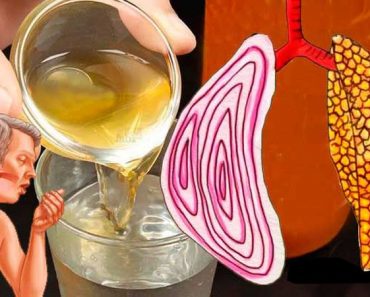 Tenía mucha flema y moco en todo mi cuerpo, garganta, pulmones y nariz pero con este simple remedio casero la saque toda te lo recomiendo Tenía mucha flema y moco en todo mi cuerpo, garganta, pulmones y nariz pero con este simple remedio casero la saque toda te lo recomiendo