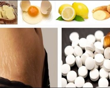 Elimina Rápidamente Las Estrías Con Aspirina !Los Resultados Te Van A Sorprender!