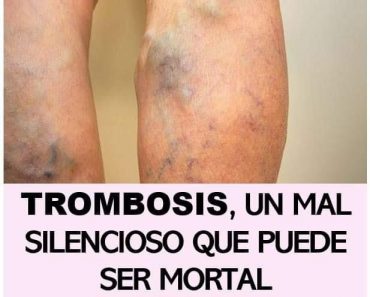 Trombosis, un Mal Silencioso que Puede ser Mortal Trombosis, un Mal Silencioso que Puede ser Mortal
