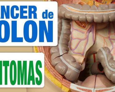 La tasa del cáncer de colon aumenta, conoce los 5 síntomas que debes tener en cuenta La tasa del cáncer de colon aumenta, conoce los 5 síntomas que debes tener en cuenta